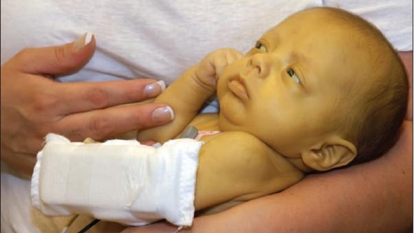 ملف كامل عن مرض الصفراء لدى الأطفال حديثي الولادة 983