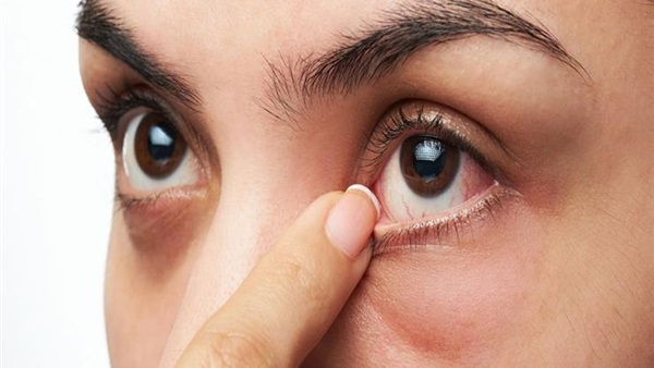 البوابة نيوز تعرف على أسباب احمرار العين المتكرر وطرق العلاج